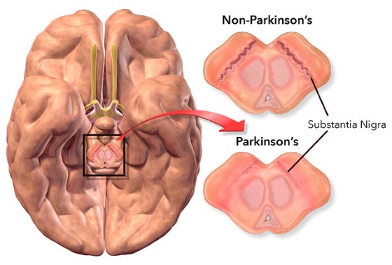 Při onemocnění Parkinsonem dochází k poklesu nervových buněk v mozkové části zvané Substantia nigra (neboli černá substance) a patologickým změnám v těchto tkáních